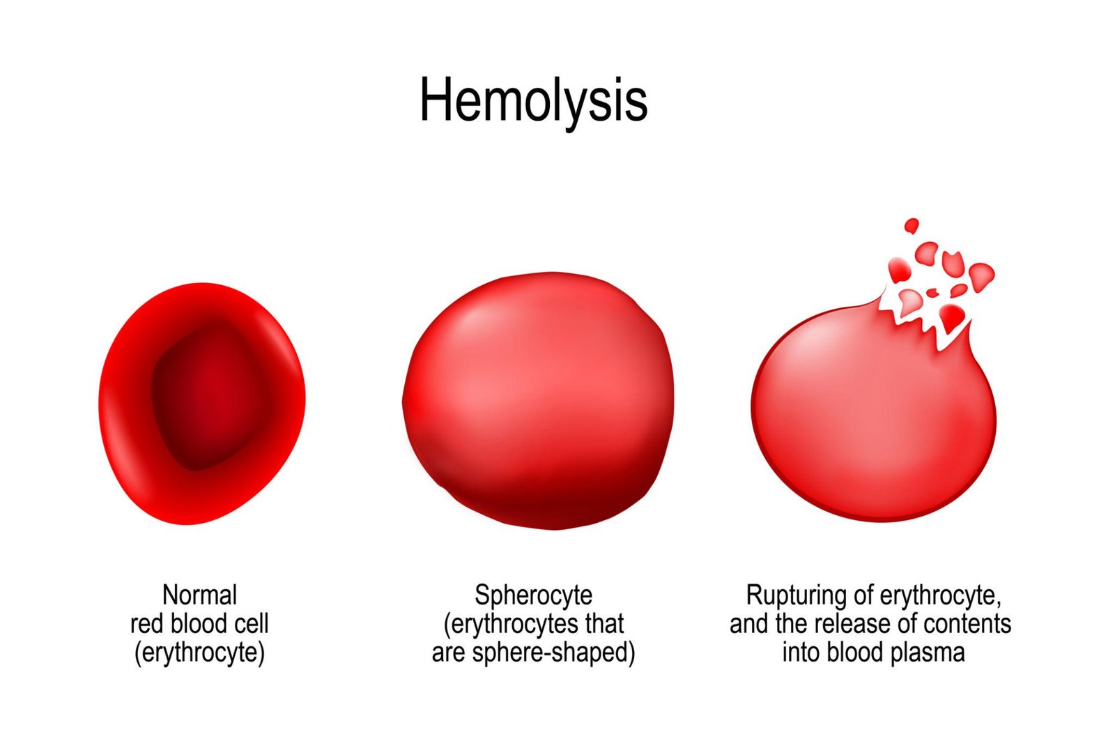 Hemolytic anemia