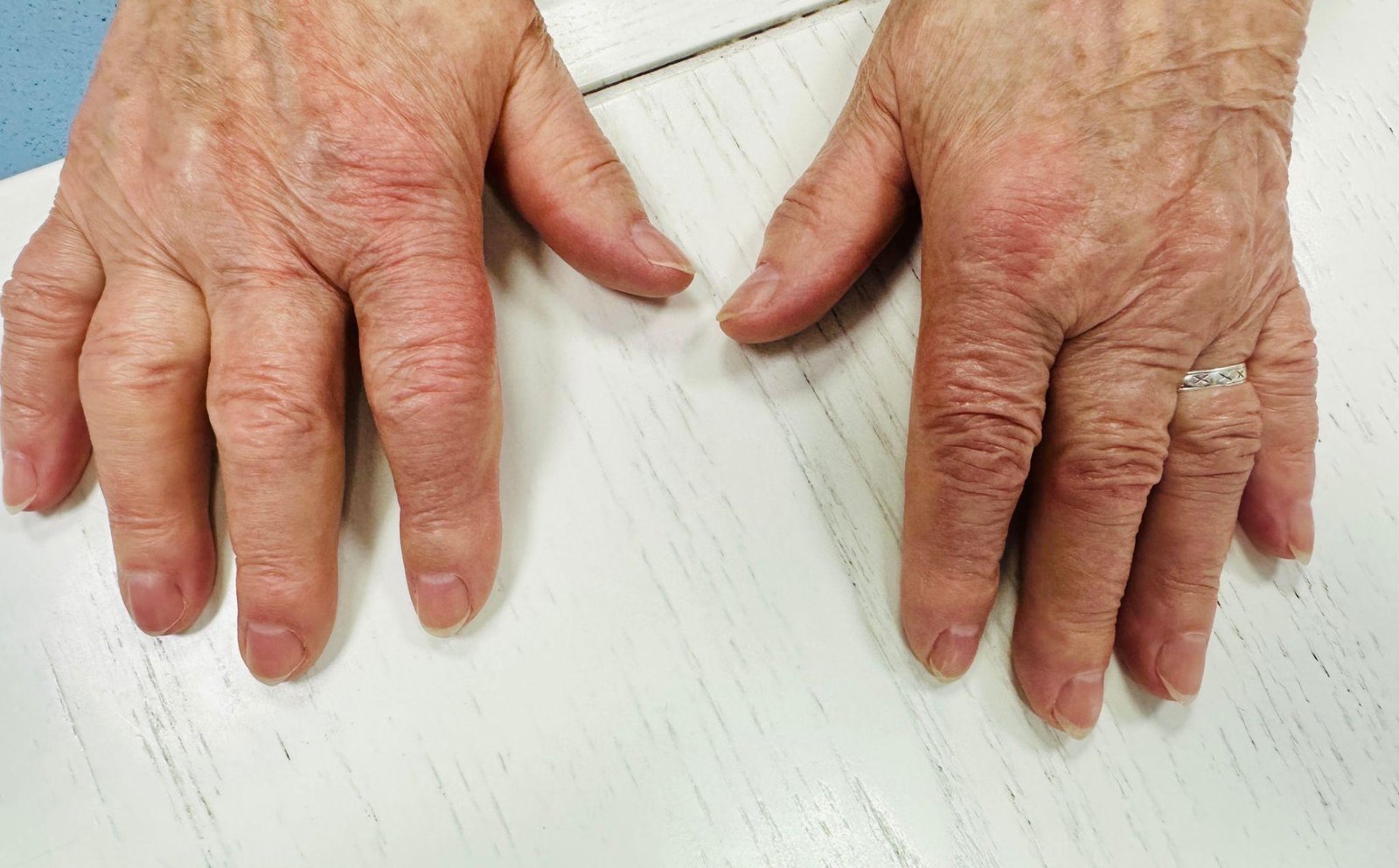 Autoimmune diseases