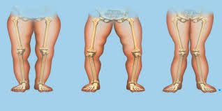 Rickets